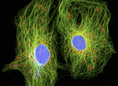 Cancer cells as seen through a special microscope allowing observation of living organic material. The blue nucleuses have approximately 12 micrometers in diameter.