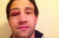 Kevin McLaughlin’s eye does not look good